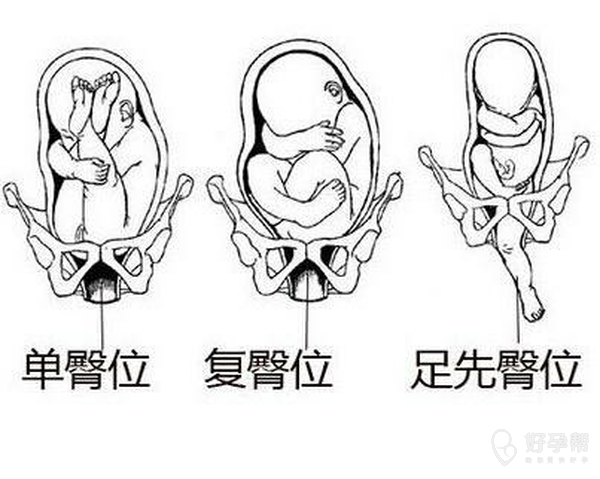 八个月臀位脐带绕颈图，胎儿状况与应对策略